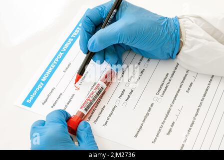 aerial view doctor with nitrile gloves fill blood test form for monkeypox with hands positive result Stock Photo