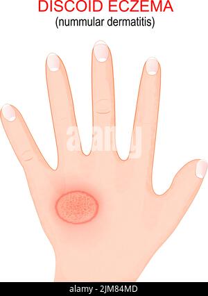 Nummular dermatitis. Discoid eczema is a chronic skin condition that causes skin to become itchy, swollen and cracked in circular patches. Close-up Stock Vector