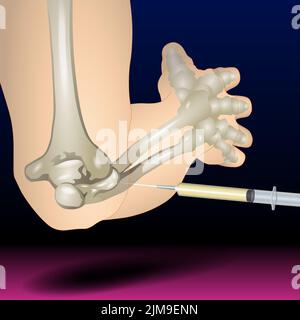 Elbow Bone Illustration - Syringe, Injection Stock Photo