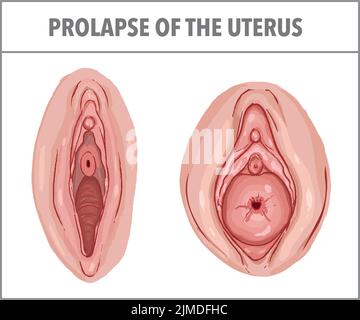 Medical Illustration Showing Difference Normal Uterus Prolapsed