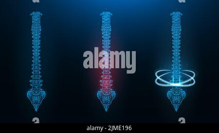 Polygonal vector illustration of a human spine. Image of a healthy, sick and recovering spine. Stock Photo