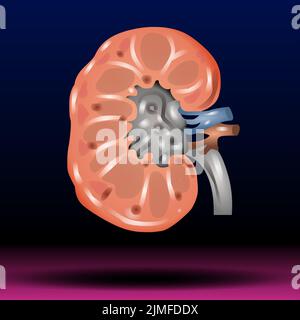 Nephrolithiasis Kidney Stones Disease Or Urolithiasis. Renal Calculus ...