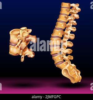 Spinal Stenosis medical concept as a degenerative illness in the human vertebrae causing compressed spine nerves human body disease as a illustration Stock Photo