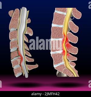 Spinal Stenosis Stock Photo