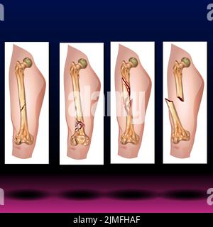 Thigh Bones Stock Photo