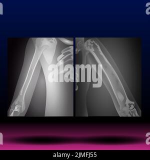X-Ray of Hand - Upper Limb Stock Photo