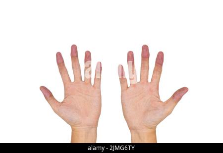 Cyanotic hands or central cyanosis or blue hands at Southeast Asian ...