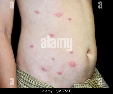 Multiple itchy mosquito or insect bite wheals; red spots on trunk of Southeast Asian, Chinese adult young man. Isolated on black background. Stock Photo