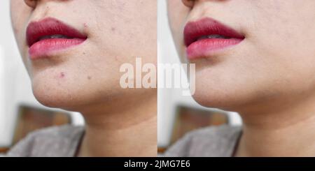 Acne, black spots and scars on face of Asian young woman. Before and after treatment Stock Photo