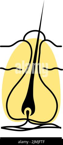 Illustration of a worsening furuncle, a condition that is worsened by ...