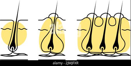 Image of skin problems, rough skin, acne, early to advanced folliculitis Stock Vector