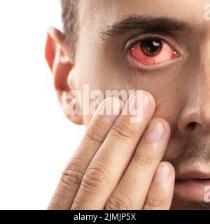 Man with the Subconjunctival hemorrhage in his eye Stock Photo