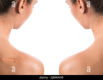 Comparision of female shoulder after scar removing Stock Photo