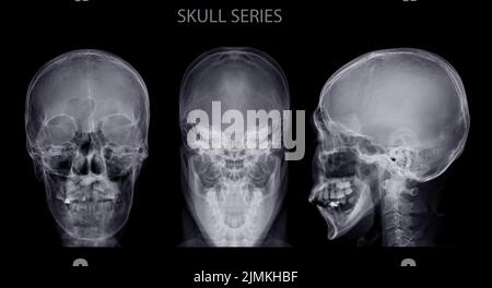 Collection of  Skull x-ray image name is skull series isolated on Black Background. Stock Photo