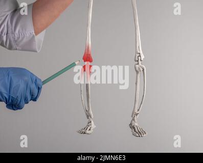 Doctor hand pointing to skeleton knee with red spot. Leg pain. Arthritis, infection, gout, ruptured ligaments, torn cartilage. Skeletal system anatomy Stock Photo