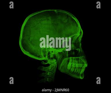 Human skull. Green X-ray image on black background Stock Photo