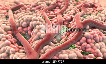 Animatied of infected wound ,bacteria , pus, abscess