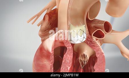Illustration of coronary angioplasty stent insertion Stock Photo - Alamy