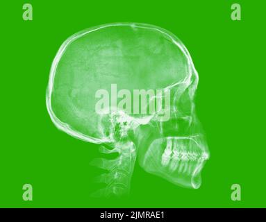 Human skull. X-ray image on green background Stock Photo
