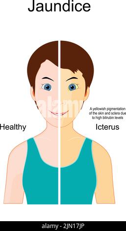 Jaundice. The Comparison between Healthy person and person with Icterus. yellowish pigmentation of the skin and sclera due to high bilirubin levels. Stock Vector