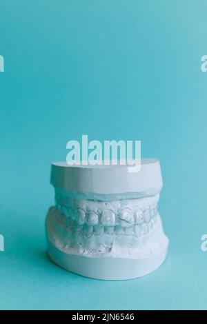 Plaster mould of human jaw with transparent aligner, invisible retainer ...