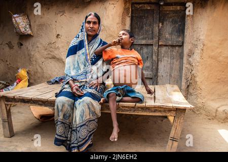 Prominent abdominal distension in Southeast delhi, Indian man. Distended abdomen may be due to ascites with cirrhosis, intestinal obstruction or fat. Stock Photo