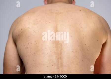 tinea versicolor on the back. pityriasis versicolor problem with skin Stock  Photo - Alamy