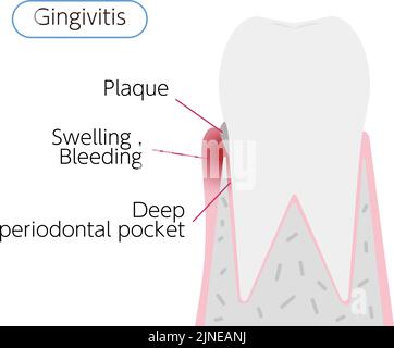 Illustration by stage of periodontal disease: Gingivitis Stock Vector