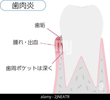 Illustration by stage of periodontal disease: Gingivitis Translation: Gingivitis, plaque, swelling / bleeding, deep periodontal pockets Stock Vector