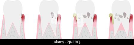 Illustration by stage of periodontal disease: order of progress Stock Vector