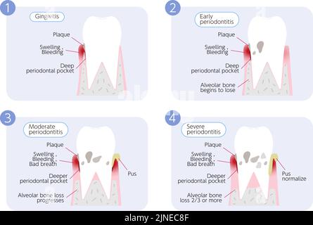 Periodontal disease progression illustration, 4 stages Stock Vector