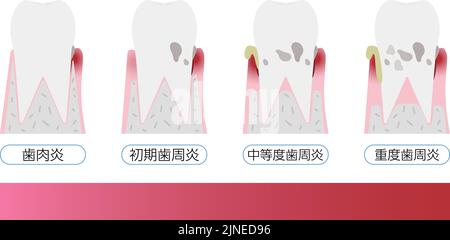 Illustration by stage of periodontal disease: order of progress Translation: Gingivitis, early periodontitis, moderate periodontitis, severe periodont Stock Vector