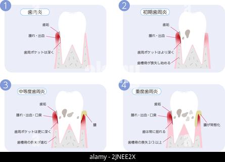 Periodontal disease progression illustration, 4 stages Translation: Gingivitis, early periodontitis, moderate periodontitis, severe periodontitis Stock Vector