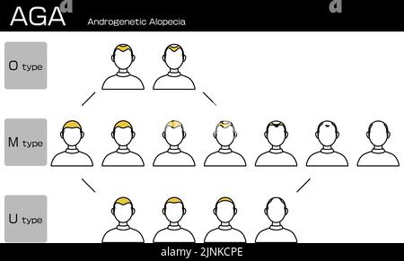 Illustration of each type of AGA androgenetic alopecia and progress stage Stock Vector