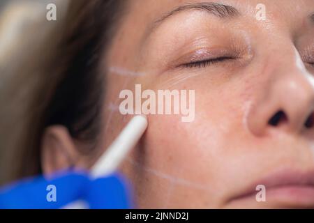 Mesotherapy thread face lift procedure Stock Photo
