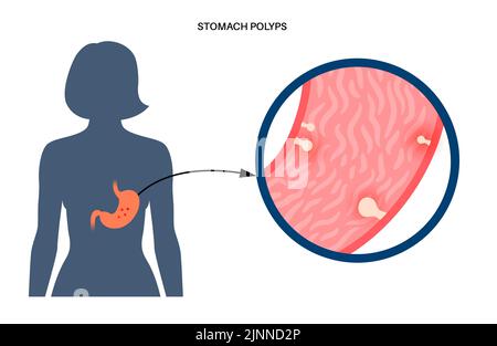 Stomach polyps, illustration Stock Photo