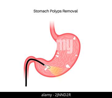 Stomach polyp removal, illustration Stock Photo