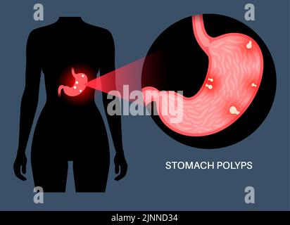 Stomach polyps, illustration Stock Photo