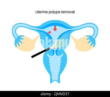 Uterine polyps, illustration Stock Photo