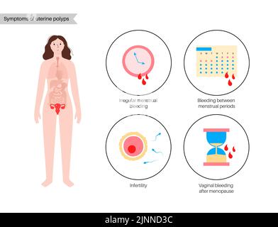 Uterine polyps, illustration Stock Photo