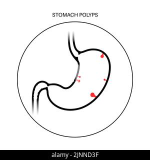 Stomach polyps, illustration Stock Photo