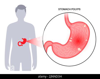 Stomach polyps, illustration Stock Photo