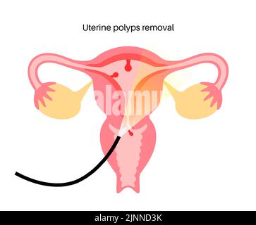 Uterine polyps, illustration Stock Photo