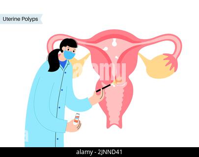 Uterine polyps, illustration Stock Photo