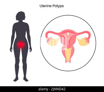 Uterine polyps, illustration Stock Photo