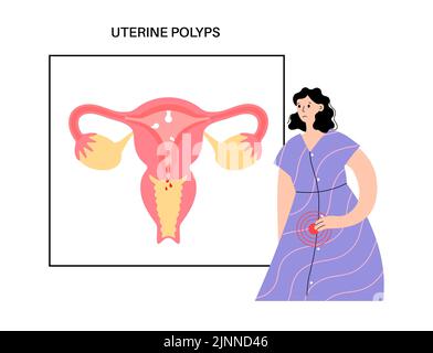 Uterine polyps, illustration Stock Photo