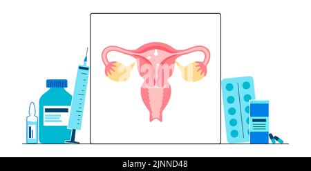 Uterine polyps, illustration Stock Photo