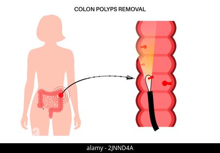 Colon polyps, illustration Stock Photo