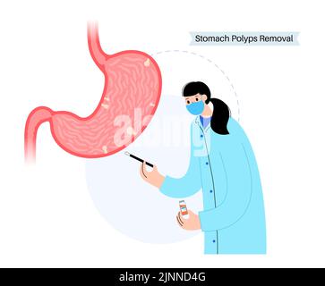 Stomach polyp removal, illustration Stock Photo