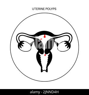 Uterine polyps, illustration Stock Photo